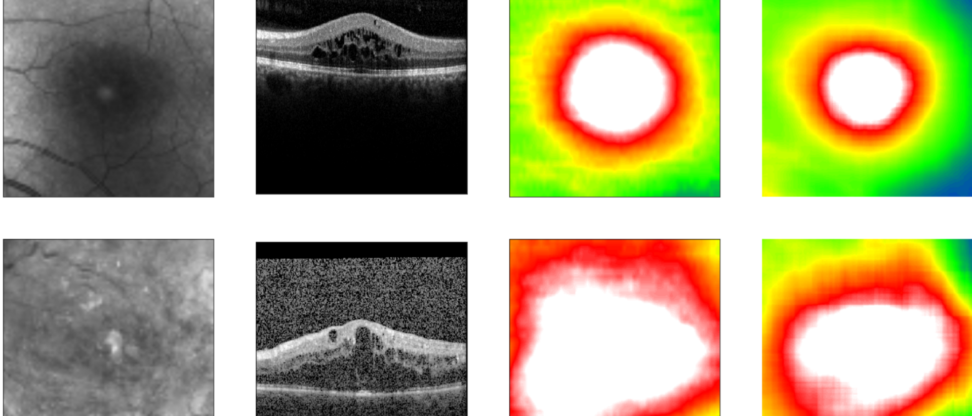 Algorithm predicts retinal thickness.